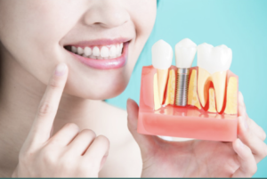 Dental Implant Care – Proper Implant Maintenance