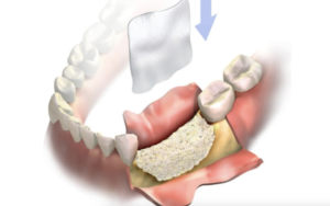 What is Thin Dental Bone? Can Thin Alveolar Bone Support Dental Implants?