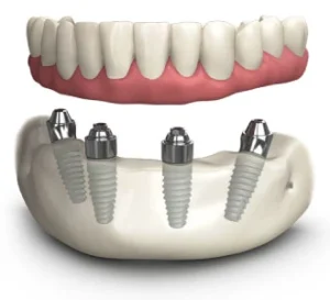 The overview of full-arch dental implant solution