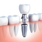 Important Information About Dental Implants: Before, During, and After the Procedure
