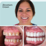Risks of Getting Dental Porcelain Crowns Abroad (Dental Tourism)