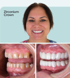 Risks of Getting Dental Porcelain Crowns Abroad (Dental Tourism)